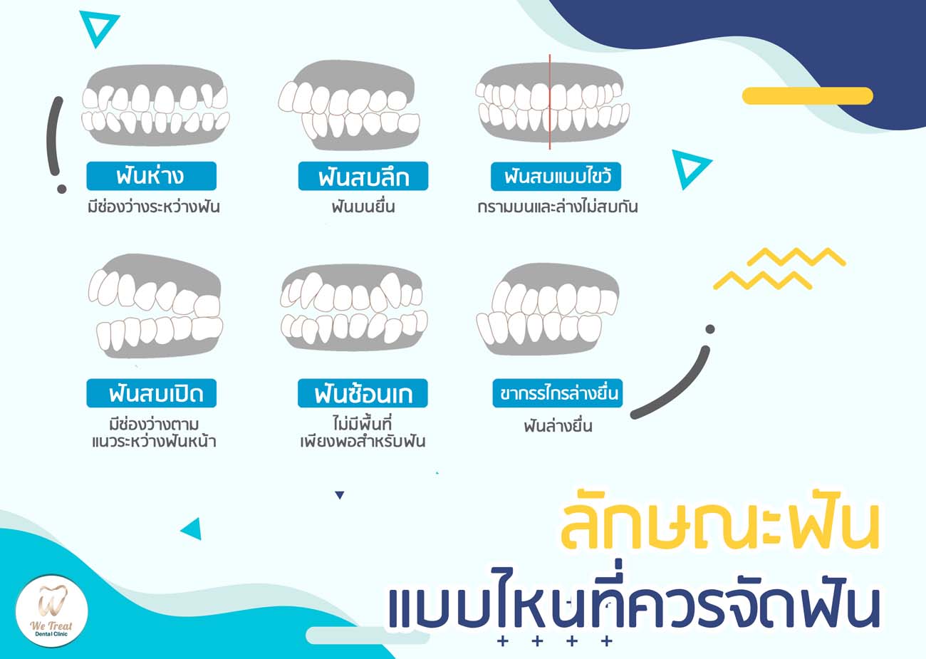 02 ลักษณะฟันแบบไหนที่ควรจัดฟัน