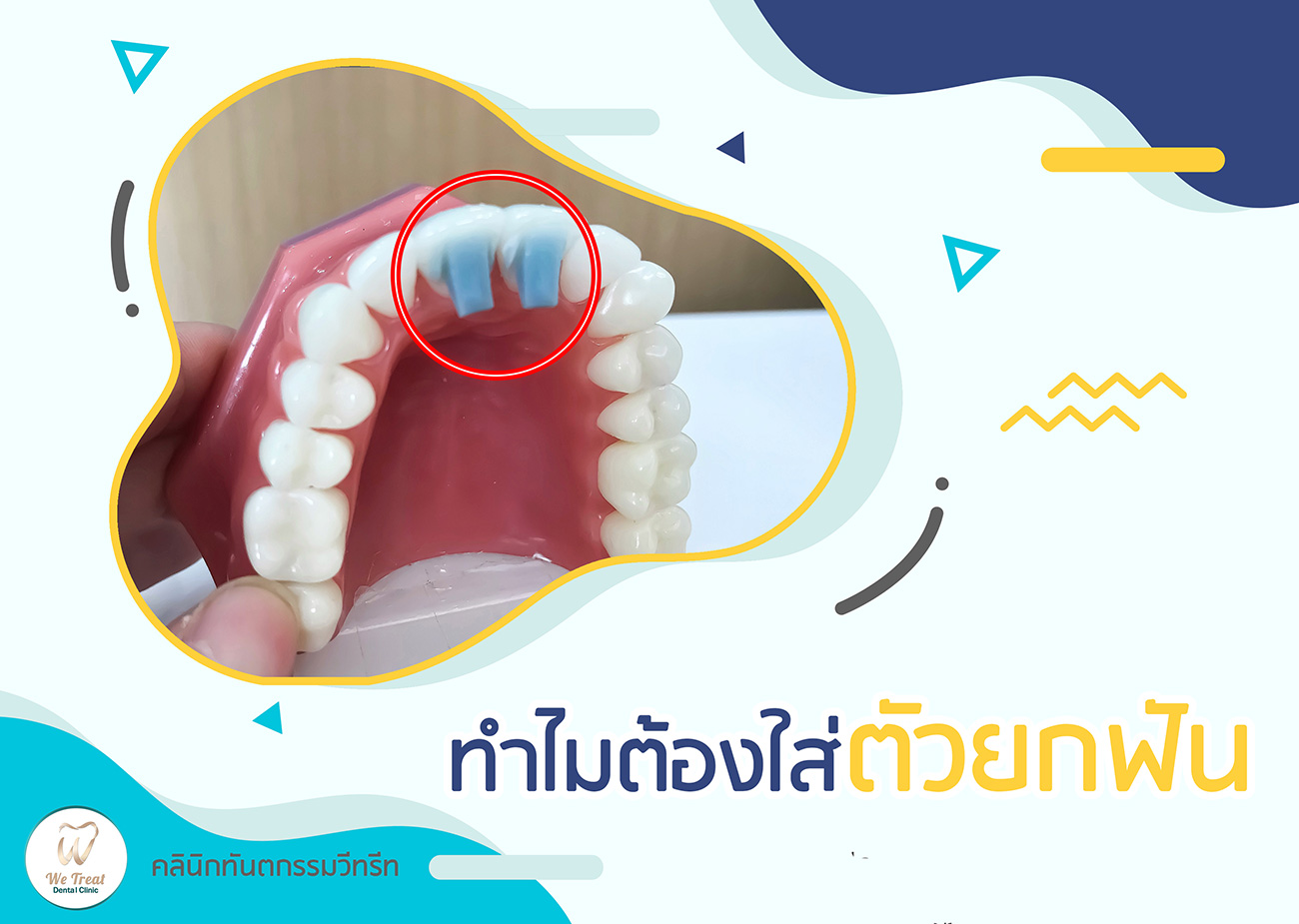 20-ทำไมต้องใส่ตัวยกฟัน