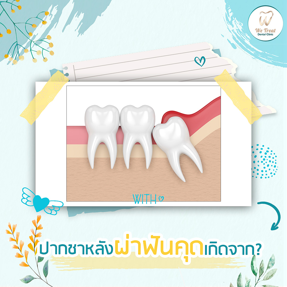 กังวลไหม? ผ่าฟันคุดแล้วเกิดอาการปากชา - We Treat Dental Clinic คลินิก ...