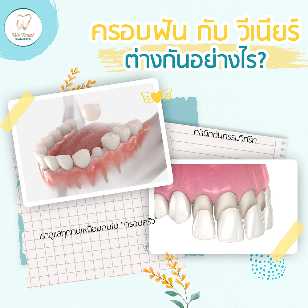 25T4-ครอบฟัน-กับวีเนียร์