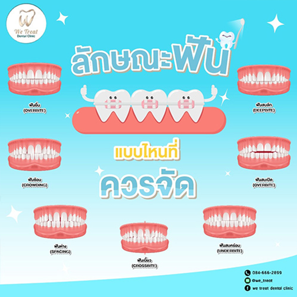 ลักษณะฟันที่ควรจัด-สาระน่ารู้