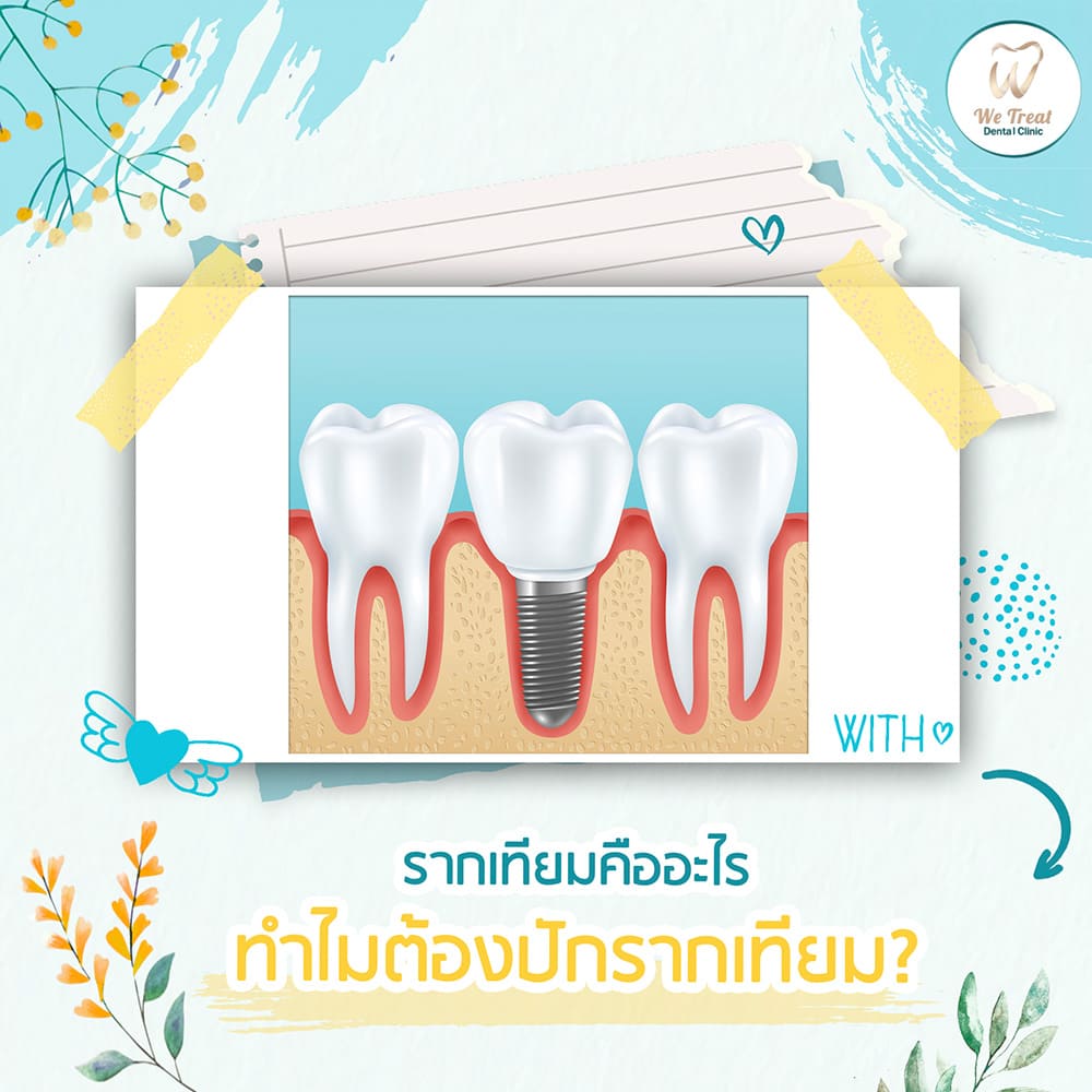 รากเทียมคืออะไร-สาระน่ารู้