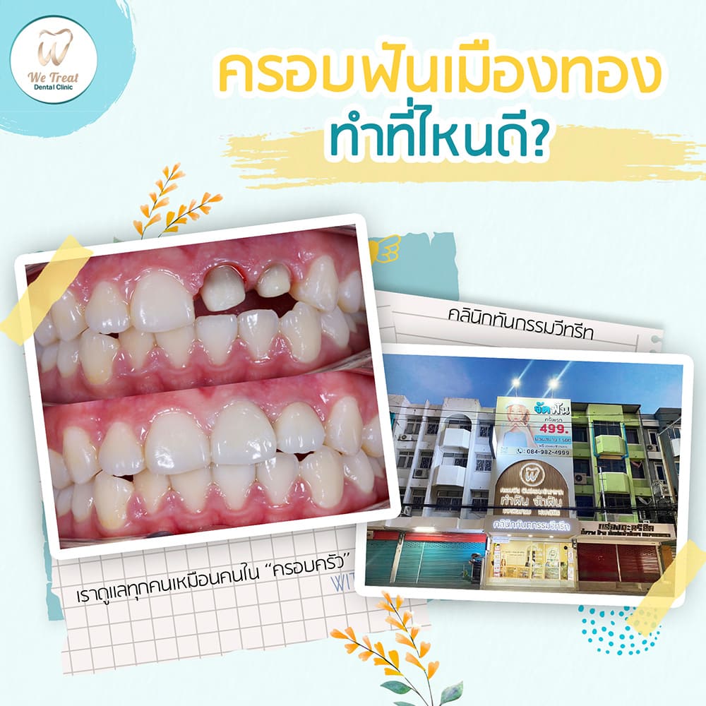 ครอบฟันเมืองทองทำที่ไหนดี-สาระ